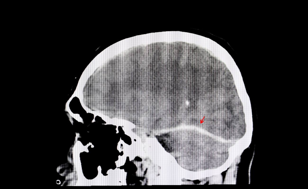 Types of Traumatic Brain Injuries Caused by Car Accidents